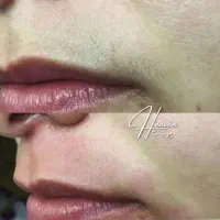 جشنواره لیزر موهای زائد بدن در مطب پزشک فول ۶۹۰