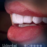 کامپوزیت ایمپلنت لمینت ارتودنسی