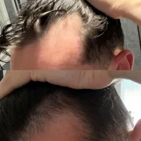 پشمالو باش    رشد مجدد / پر پشتی / مو