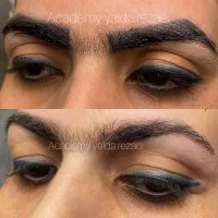 ریمو تتو فیبروز میکروبلیدینگ هاشور کراتین شیدینگ
