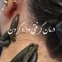 زالو درمانی حجامت بادکش