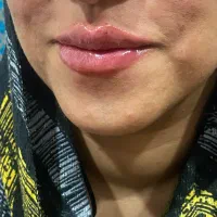 ژل ووچالگونه و پی ارپی
