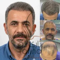 کلینیک کاشت مو بیمارستان ارتش همدان (تضمینی) prp