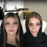 فیلر، بوتاکس،اصلاح بینیPRP و جوانسازی آنالیز  چهره