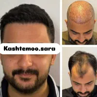 کاشت مو