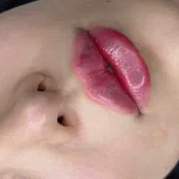 هایفوتراپی صورت با دستگاه هایفوگلد ۲۰۲۵