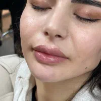 ژل،بوتاکس ،فیلر