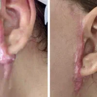 درمان گوشت اضافه بر اثر سوختگی وچاقو، غیره