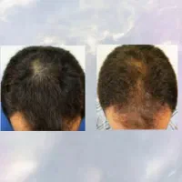 فرصت دوباره برای رشد مجددریش