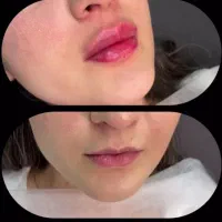 جشنواره تابستانه ژل و بوتاکس