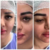 کاشت ابرو با قیمت استثنائی