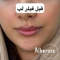 جشنواره لیزر موهای زائد،ژل و بوتاکس...