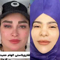 20 % تخفیف روز پزشک جراحی فوق تخصصی بلفاروپلاستی
