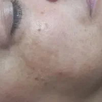 پلاژن تراپی و فیشال تخصصی صورت و بدن
