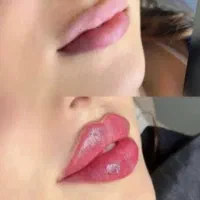 ژل‌ بوتاکس فیلر انزیم مزوژل اموزش پی ار پی فولفیس