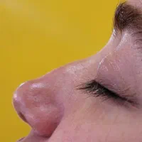 اصلاح فرم ( قوز ) بینی