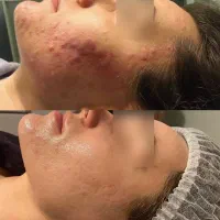 ریموو تتو،رفع آکنه و اسکار و لک و تیرگی،RF