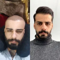 کاشت مو و ابرو