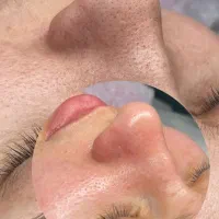 فیشیال در مطب برای بانوان و آقایان