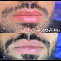 روشن سازی لب نچرال ، اسکالپ سر ، فیبروز ابرو نچرال