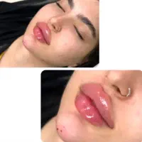 مدل رایگان ژل و بوتاکس و مزو پوست و مو