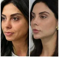 جشنواره تخفیفات ژل بوتاکس فیلر