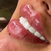 تزریق چربی باسن تزریق ژل وبوتاکس