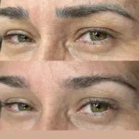 پاک کردن تاتو های قدیمی بدون اسیب اولین باردرساوه