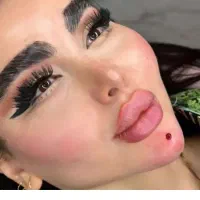 تزریق ژل۵۰۰وآموزش۵ بوتاکس ژل لب گونه زاویه زیرچشم