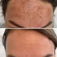 تونر خفن همه کاره ضدلک، جوش