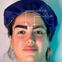 آنیل کاشت