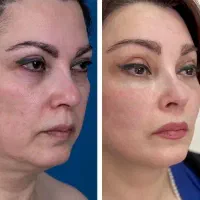 پکیج جوانساز صورت در دوره 30روزه