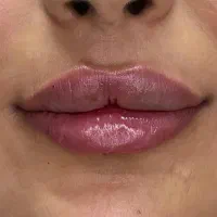 جشنواره ژل بوتاکس فیلر پی ار پی