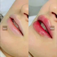 مدل رایگان بوتاکس صورت فیلرprpو مزو صورتو ومو