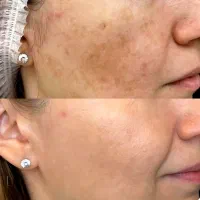 لیزر کیوسوییچ تهرانسر پاک کردن تتو و لک های مقاوم