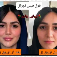 آف ویژه فول فیس/ژل لب روسی/چانه/گونه/بوتاکس زاویه