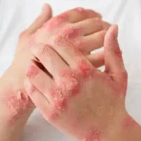 پسوریازیس فقط یک خطر نیست