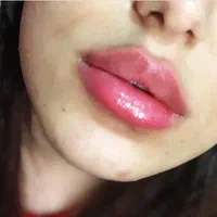 مطب پزشک ژل و بوتاکس ژل لب گونه چونه فیلر بینی