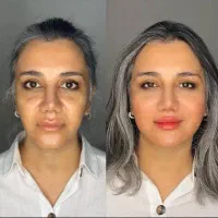 مدل خانم جهت فیلر صورت
