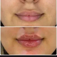 تخفیفات شگفت انگیز لیزر بوتاکس فیلر ژل