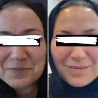 ضدلک تضمینی نتیجه بگیر اورجینال