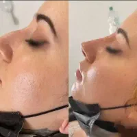 انجام و آموزش ژل بوتاکس فیلر مزوتراپی