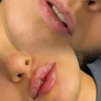 آموزش کامل فیلر بوتاکس مزو آنزیم