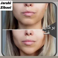 ساکشن غبغب نقد واقساط بوکال فت بلفارو کاشت ابرو|خدمات آرایشگری و زیبایی|تهران, پونک|دیوار