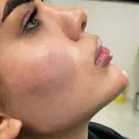 جشنواره ساکشن غبغب تکنیک v لاین و فیلر بادی