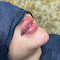 تزریق ژل و بوتاکس لیزر موهای زاید