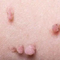 رفع دائمی زگیل و تبخال تناسلی
