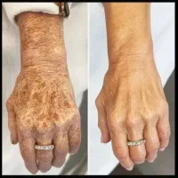 تخصصی ترین ضد لک جهانی بیوممتیک