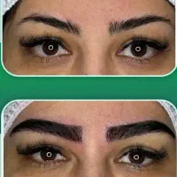 کاشت ابرو ۱۰ میلیون کاشت مو ۲۵ میلیون