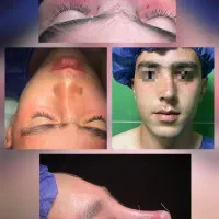 جراحی بینی گوشتی و استخوانی / مشاوره تخصصی